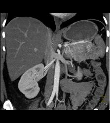 Islet Cell Tumor of the Tail of the Pancreas - CTisus CT Scan