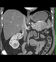 Islet Cell Tumor of the Tail of the Pancreas - CTisus CT Scan