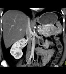 Islet Cell Tumor of the Tail of the Pancreas - CTisus CT Scan