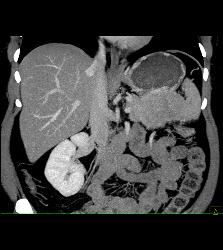 Islet Cell Tumor of the Tail of the Pancreas - CTisus CT Scan