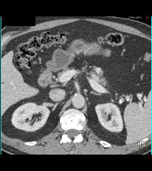 1 Cm Islet Cell Tumor in the Body of the Pancreas - CTisus CT Scan