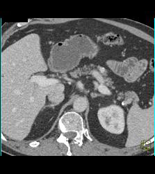 1 Cm Islet Cell Tumor in the Body of the Pancreas - CTisus CT Scan