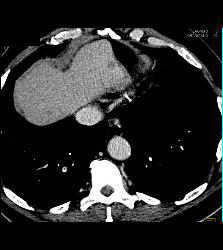 Carcinoma of the Tail of the Pancreas With Liver Metastases. Incidental Pulmonary Embolism (PE) Found - CTisus CT Scan