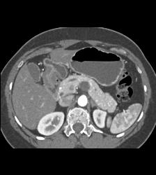 Intraductal Papillary Mucinous Neoplasm (IPMN) - CTisus CT Scan