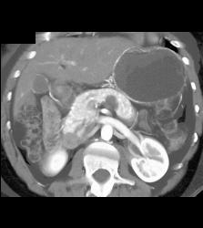 Intraductal Papillary Mucinous Neoplasm (IPMN) - CTisus CT Scan