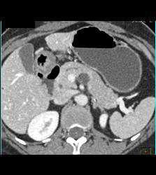 Intraductal Papillary Mucinous Neoplasm (IPMN) - CTisus CT Scan