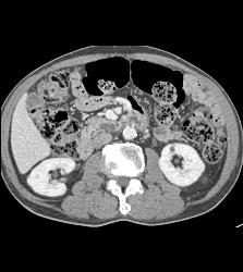 1 Cm Intraductal Papillary Mucinous Neoplasm (IPMN) - CTisus CT Scan