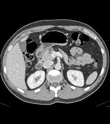 1 Cm Intraductal Papillary Mucinous Neoplasm (IPMN) - CTisus CT Scan