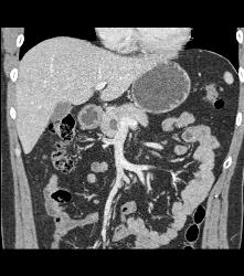 1 Cm Intraductal Papillary Mucinous Neoplasm (IPMN) - CTisus CT Scan