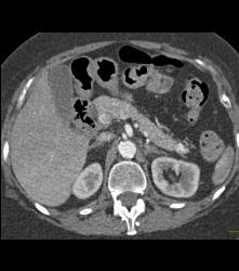 Islet Cell Tumor in the Tail of the Pancreas - CTisus CT Scan