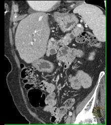 Intraductal Papillary Mucinous Neoplasm (IPMN) and Lipoma of the Duodenum - CTisus CT Scan