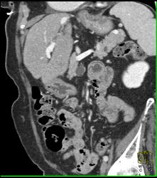 Intraductal Papillary Mucinous Neoplasm (IPMN) and Lipoma of the Duodenum - CTisus CT Scan