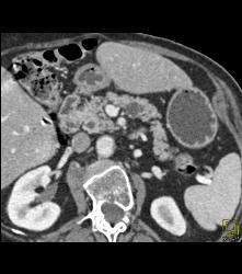 Intraductal Papillary Mucinous Neoplasm (IPMN) and Lipoma of the Duodenum - CTisus CT Scan