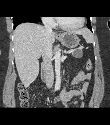 Intraductal Papillary Mucinous Neoplasm (IPMN) in Tail of the Pancreas - CTisus CT Scan