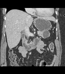 Intraductal Papillary Mucinous Neoplasm (IPMN) in Tail of the Pancreas - CTisus CT Scan