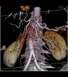 Islet Cell Tumor With Tumor Being of Increased Neovascularity - CTisus CT Scan