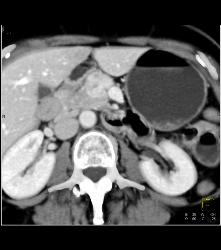 Islet Cell Tumor With Tumor Being of Increased Neovascularity - CTisus CT Scan