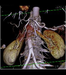 Islet Cell Tumor With Tumor Being of Increased Neovascularity - CTisus CT Scan