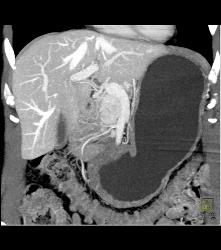 Islet Cell Tumor With Tumor Being of Increased Neovascularity - CTisus CT Scan