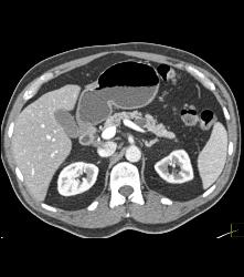 Intraductal Papillary Mucinous Neoplasm (IPMN) - CTisus CT Scan