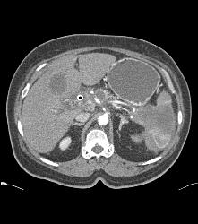 Pancreatic Cancer Invades the Spleen. Nodes in Porta Seen With Stent in Common Bile Duct (CBD) - CTisus CT Scan