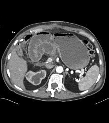 Post Whipple Procedure With Delayed Gastric Emptying - CTisus CT Scan