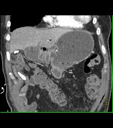 Post Whipple Procedure With Delayed Gastric Emptying - CTisus CT Scan