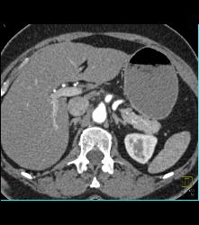 1cm Islet Cell Tumor in the Tail of the Pancreas- Better Seen on Venous Phase - CTisus CT Scan