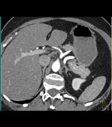 1cm Islet Cell Tumor in the Tail of the Pancreas- Better Seen on Venous Phase - CTisus CT Scan