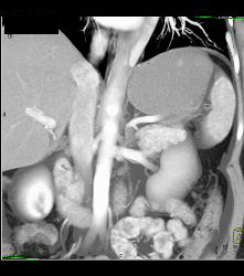 1cm Islet Cell Tumor in the Tail of the Pancreas- Better Seen on Venous Phase - CTisus CT Scan