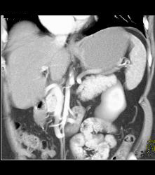 1cm Islet Cell Tumor in the Tail of the Pancreas- Better Seen on Venous Phase - CTisus CT Scan