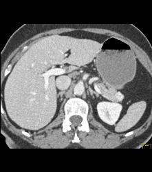 1cm Islet Cell Tumor in the Tail of the Pancreas- Better Seen on Venous Phase - CTisus CT Scan