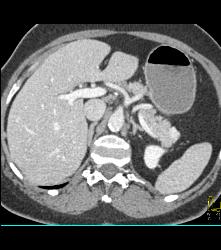 1cm Islet Cell Tumor in the Tail of the Pancreas- Better Seen on Venous Phase - CTisus CT Scan