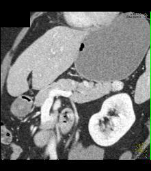 1cm Islet Cell Tumor in the Tail of the Pancreas- Better Seen on Venous Phase - CTisus CT Scan