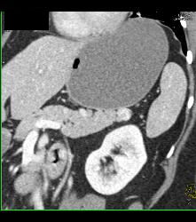 1cm Islet Cell Tumor in the Tail of the Pancreas- Better Seen on Venous Phase - CTisus CT Scan