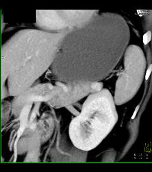 1cm Islet Cell Tumor in the Tail of the Pancreas- Better Seen on Venous Phase - CTisus CT Scan