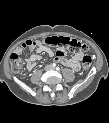 Pancreatic Cancer Encases PV/SMV/splenic Vein Confluence With Extensive Collaterals - CTisus CT Scan