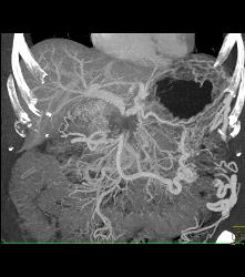 Pancreatic Cancer Encases PV/SMV/splenic Vein Confluence With Extensive Collaterals - CTisus CT Scan