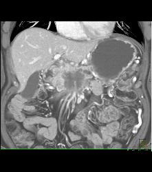 Pancreatic Cancer Encases PV/SMV/splenic Vein Confluence With Extensive Collaterals - CTisus CT Scan