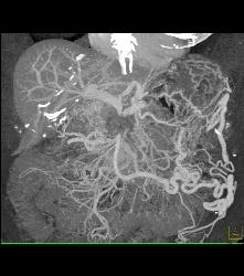 Pancreatic Cancer Encases PV/SMV/splenic Vein Confluence With Extensive Collaterals - CTisus CT Scan