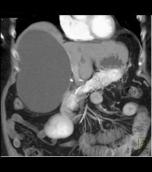 Islet Cell Tumor of the Tail of the Pancreas Plus Old Hematoma of the Left Adrenal- Cystic Mass With Calcification - CTisus CT Scan