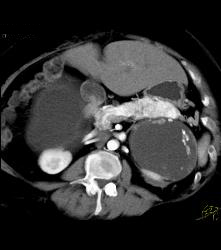 Islet Cell Tumor of the Tail of the Pancreas Plus Old Hematoma of the Left Adrenal- Cystic Mass With Calcification - CTisus CT Scan