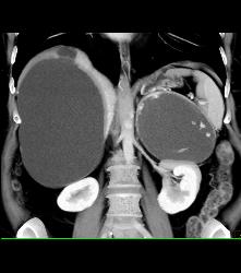 Islet Cell Tumor of the Tail of the Pancreas Plus Old Hematoma of the Left Adrenal- Cystic Mass With Calcification - CTisus CT Scan