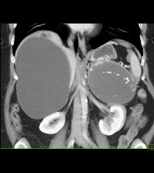 Islet Cell Tumor of the Tail of the Pancreas Plus Old Hematoma of the Left Adrenal- Cystic Mass With Calcification - CTisus CT Scan