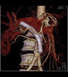 Stent in Common Bile Duct (CBD) in Patient With Carcinoma of the Head of the Pancreas - CTisus CT Scan