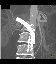 Stent in Common Bile Duct (CBD) in Patient With Carcinoma of the Head of the Pancreas - CTisus CT Scan