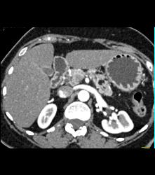 Stent in Common Bile Duct (CBD) in Patient With Carcinoma of the Head of the Pancreas - CTisus CT Scan