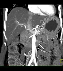 Stent in Common Bile Duct (CBD) in Patient With Carcinoma of the Head of the Pancreas - CTisus CT Scan