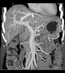 Stent in Common Bile Duct (CBD) in Patient With Carcinoma of the Head of the Pancreas - CTisus CT Scan