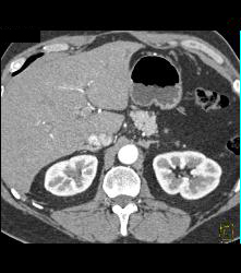 1cm Intraductal Papillary Mucinous Neoplasm (IPMN) - CTisus CT Scan